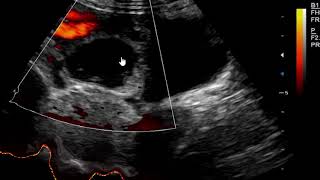 Hemorrhagic Corpus luteum cyst on Ultrasound scan [upl. by Epillihp]