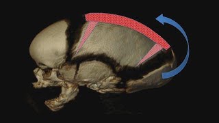 What is Sagittal Craniosynostosis [upl. by Elyssa279]