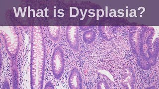 What is Dysplasia  Pathology mini tutorial [upl. by Claretta559]