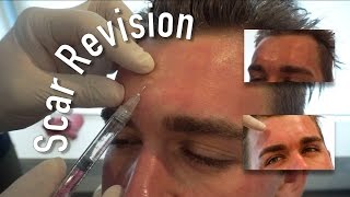 Scar Revision Treatment ft Matt Crawford [upl. by Arbmahs973]