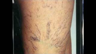 Varicose Veins Treatment [upl. by Aubreir]