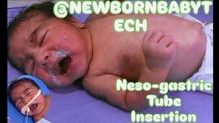 Nesogastric NG tube Insertion in neonatenewborn orogastric OG tube neonate feeding tube [upl. by Sirroned988]