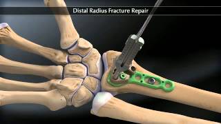 Arthrex Distal Radius Fracture Fixation [upl. by Adihaj]