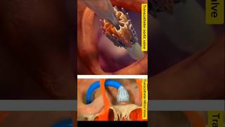 AltavalveTranscatheter Aortic amp MitralValves Replacement TMVRshorts animationviralytshorts [upl. by Eilagam]