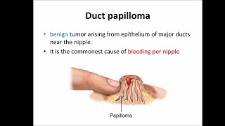 Duct papilloma [upl. by Raymond689]