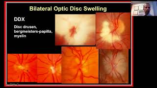 Approach to the Patient with Bilateral Optic Disc Swelling [upl. by Tessi]