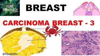 Diseases of Breast Part 6 Breast carcinoma InvasiveTypes MorphologyPrognosis amp treatment [upl. by Morlee]