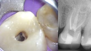 LIVE Molar Root Canal Procedure  Pulp Stone Removal  MBII Canal [upl. by Trauts152]