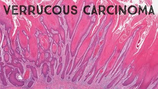 Verrucous carcinoma its NOT caused by HPV pathology dermpath dermatology dermatopathology [upl. by Acim662]