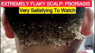 Satisfying Removal of Extremely Flaky Scalp Psoriasis  Causes amp Removal [upl. by Herb997]