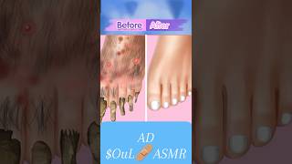 ASMR Satisfying Toenail of Athletes foot treatment animation  Athletes foot care  TINGLES [upl. by Annoik612]