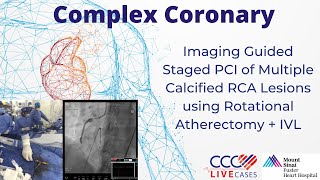 Imaging Guided Staged PCI of Multiple Calcified RCA Lesions using Rotational Atherectomy  IVL [upl. by Aserehs974]