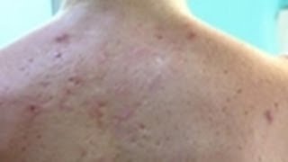 Cystic Acne  Embarrassing Bodies [upl. by Wivinia832]