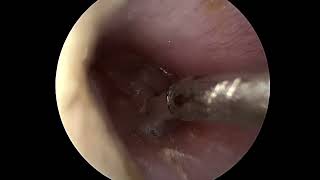 Ear tube placement myringotomy [upl. by Tomasine31]