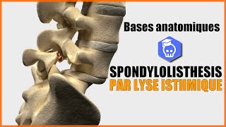 LE SPONDYLOLISTHESIS PAR LYSE ISTHMIQUE  BASES ANATOMIQUES [upl. by Swane813]