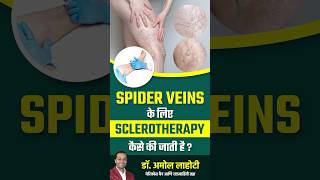 Treating Spider Veins with Sclerotherapy dramollahoti varicoseveins youtubeshorts [upl. by Mccormac391]