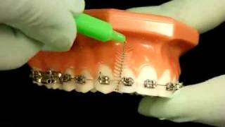 Bracesquestionscom  Brushing With Braces How to Brush Teeth [upl. by Alemat]