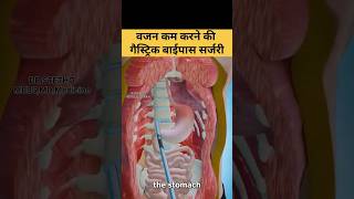 Gastric bypass surgery 3D Animation ytshorts gastricbypasssurgery weightloss health shorts [upl. by Mischa]