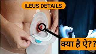 understanding ILEUS [upl. by Ahsenyt812]