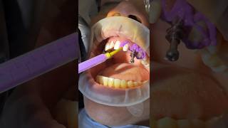 Open Tray Impression with Panasil XLight and Tray Soft Heavy kettenbachusa dentist impression [upl. by Rabaj]