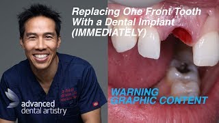 Replacing one front tooth with dental implant [upl. by Giles]