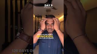 Im Using Minoxidil Daily for 5 Days to STOP Hair Loss  Day 9 minoxidil dermaroller hairloss [upl. by Kellie5]