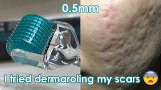 I tried dermarolling my ACNE SCARS  Demo  Review [upl. by Bolling709]