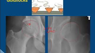 MRI Hip Imaging of Femoral Acetabular Impingement [upl. by Snodgrass401]