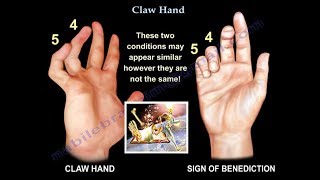 Claw Hand Ulnar Claw Hand  Everything You Need To Know  Dr Nabil Ebraheim [upl. by Akemak]