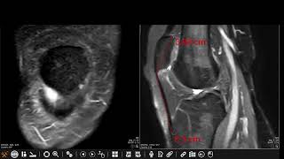 Patellar tendonlateral femoral condyle friction syndrome Hoffa fat pad impingement syndrome [upl. by Hardner]