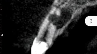 Non surgical management of Communicating resorption of 11 using MTA [upl. by Sitoeht216]