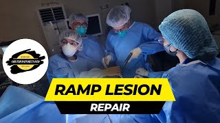 How to repair a RAMP lesion  Posteromedial portal creation  RAMP repair  Complex meniscal repair [upl. by Elacim]