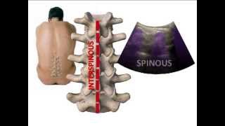 LUMBAR SPINE SONOANATOMY [upl. by Mini]