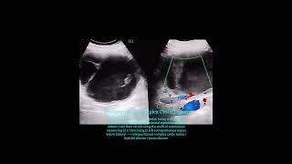 Retroperitoneal complex cystic lesion  hydatid disease  abscess [upl. by Haraj]