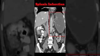 Splenic infarction  Cect Abdomen  Abdomen CT shorts radiology splenicinfrection [upl. by Beauchamp376]