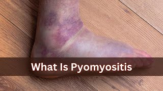 Causes of Pyomyositis [upl. by Ingra]