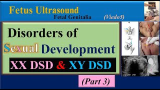 Fetus Ultrasound Disorders of Sexual Development Part3 [upl. by Ellinet]