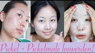 5 Tipps gegen Pickel  Pickelmale  so wirst du sie schnell los [upl. by Nahum]