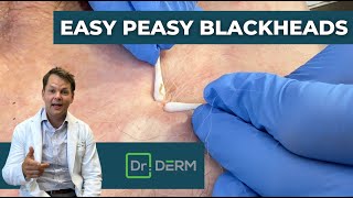 Easy Peasy Blackheads  Dr Derm [upl. by Xirdnek158]