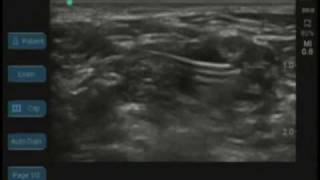 Ultrasound Guided Interscalene Catheter [upl. by Vlad409]