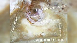 Modified Radical Mastoidectomy [upl. by Dyer]