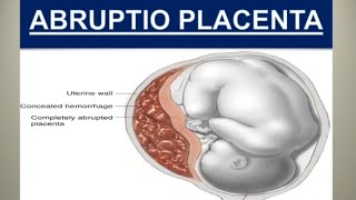 ABRUPTIO PLACENTA NOTES WITH EXPLANATION [upl. by Jacqueline]