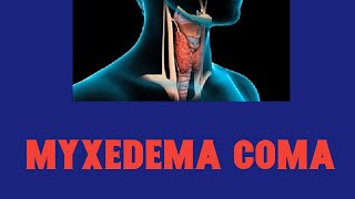 Myxedema coma  Hypothyroidism [upl. by Alliehs]