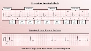 Advanced EKGs  Sinus Node Dysfunction [upl. by Aicilas]