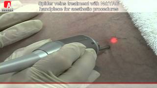 SPIDER VEINS TREATMENT NdYAG [upl. by Findlay]