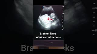 Braxton hicks contractionsmedicalimaging imaging ultrasound learning medicine viral doctor [upl. by Walls]