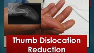 Thumb Dislocation Reduction [upl. by Wickner]