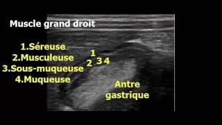 EVALUATION DU CONTENU GASTRIQUE CHEZ LENFANT PAR ECHOGRAPHIE GASTRIQUE [upl. by Niriam]