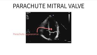 Parachute mitral valve [upl. by Argyle]