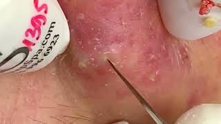 Acne Treatment 2023  Pimples Removal EP254 acne blackhdeads relaxing [upl. by Aihsei]